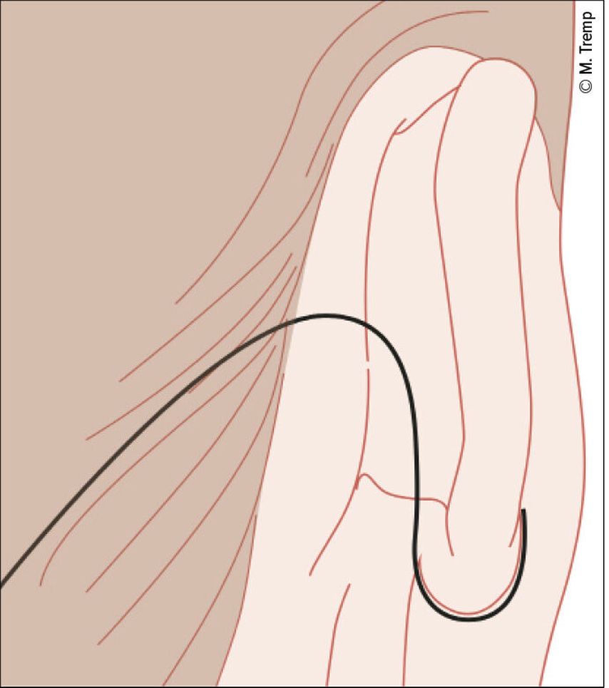 Posttragal Aktuelle Konzepte der Gesichtsstraffung - Dermatologie - Universimed ...