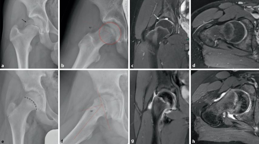 Femoroacetabuläres Impingement-Syndrom bei Jugendlichen - Orthopädie ...