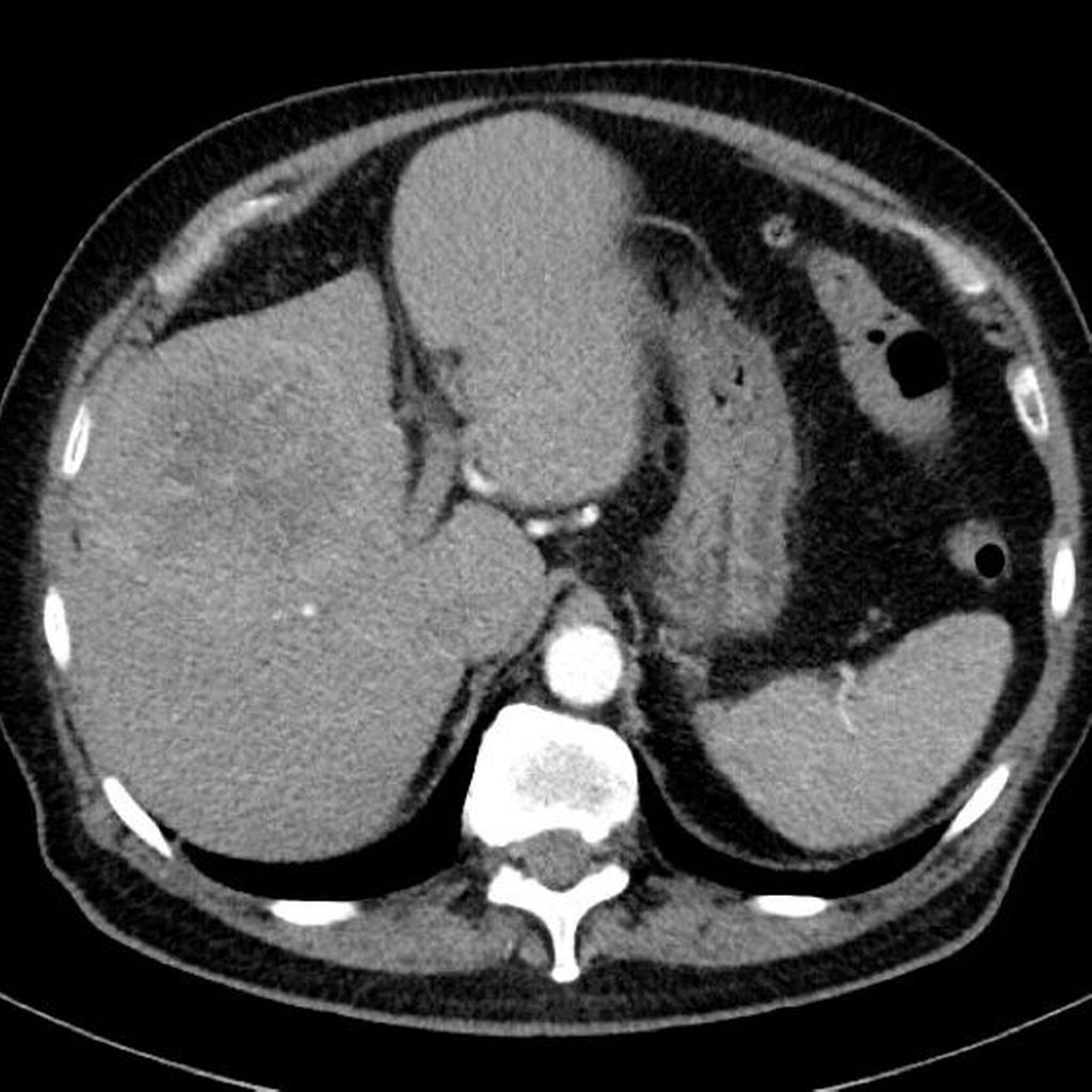 Die Multimodale Therapie Des Hepatozellul ren Karzinoms Onkologie die-multimodale-therapie-des-hepatozellul-ren-karzinoms-onkologie