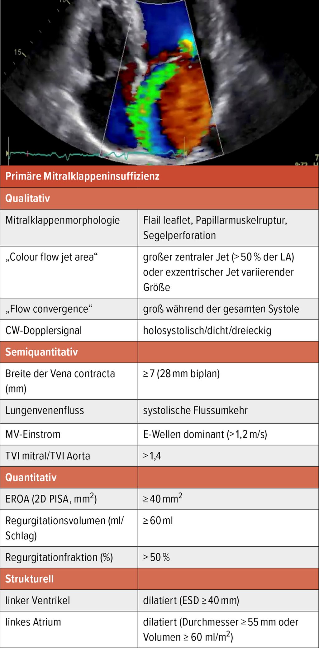 Graduierung Der Ringe Quantifizierung & interventionelle Therapie der Mitralklappeninsuffizi ...